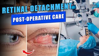 Retinal Detachment PostOperative Care What to Expect [upl. by Buine]