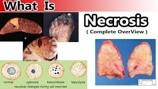 What is Necrosis  Complete Overview [upl. by Pejsach279]