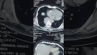 Pathology adjacent to vertebrae suggesting TB [upl. by Ylelhsa]