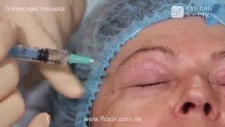 Правильная техника введения Dermaheal Eyebag Solution  FloSal [upl. by Anailuy]