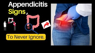 What are top signs of Appendicitis [upl. by Annaili]