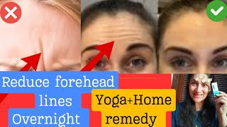 Smooth deep forehead lines over night  Inexpensive Home treatment [upl. by Konyn]