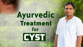 Ayurvedic Treatment for Cyst  Acharya Balkrishna [upl. by Ardekan]