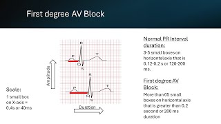 First degree AV Block [upl. by Annairam]