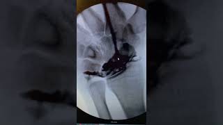 Wrist Arthrogram [upl. by Nivi]