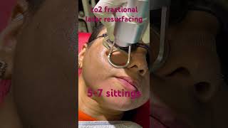 Pore size reduction by co2 fractional laser resurfacing best treatment for enlarged pores shorts [upl. by Madancy]