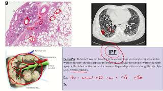 Diffuse Parenchymal Lung Disease ILD Part 2 [upl. by Bilac]