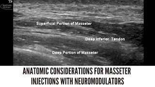 Anatomic Considerations For Masseter Injections With Neuromodulators [upl. by Bissell]