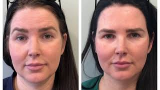 Botox Before and After [upl. by Hach]