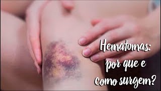 Hematomas que aparecem de nada o que pode ser [upl. by Auohs]