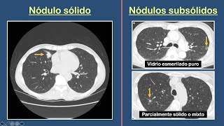 Nódulo Pulmonar Solitario [upl. by Aeli342]