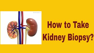 Kidney Cancer Biopsy Procedure [upl. by Aicrag]