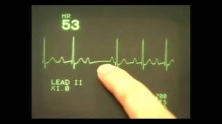 EKG ECG rhythms 4 Heart block rhythms [upl. by Wanda]