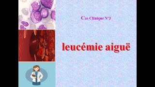 cas clinique corrigé en hémato N°3 leucémie aigue LA [upl. by Alil757]