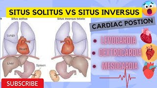 Situs Solitus vs Situs Inversus position of Heart  Levocardia  Dextrocardia  Mesocardia in Urdu [upl. by Rawley]