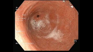 Gastric erosions Gastritis Endoscopy EsophagogastroduodenoscopyReflux esophagitisBiopsy Cancer [upl. by Karyn721]