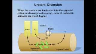 Normal Anion Gap Metabolic Acidosis ABG Interpretation  Lesson 9 [upl. by Leong]