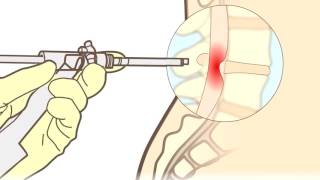 Hernia discal ¿qué es ¿Cómo se opera  Neurocirugía Torres [upl. by Zetnod]