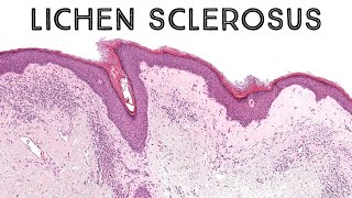 Lichen sclerosus with epidermotropism mimic of mycosis fungoides pathology dermatology dermpath [upl. by Yllehs]