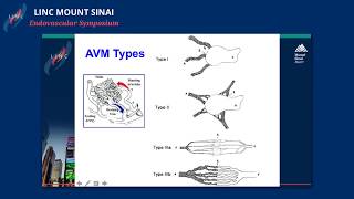 Embolization of AV Malformations Tips and Tricks [upl. by Whitnell]