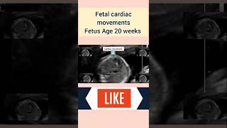 Fetal heart rate FHR medical pregnancyultrasound ultrasoundscans pregnant [upl. by Avilla]