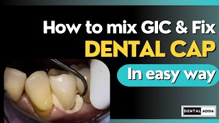 How to mix GIC for luting consistency  Dental Crown Fixing Procedure [upl. by Omsoc720]