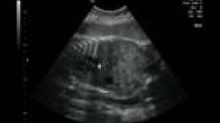 Life in the Womb IV 33 weeks ultrasound [upl. by Dunham]