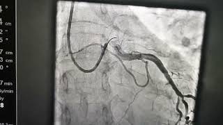 70 yr old patient with severe chest painLMS disease with ostial Lcx amp Total ostial Lad [upl. by Jilli]