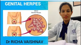 Genital herpes in females  painful ulcers in private area by Dr Richa Vaishanav Jaipur [upl. by Nilekcaj]