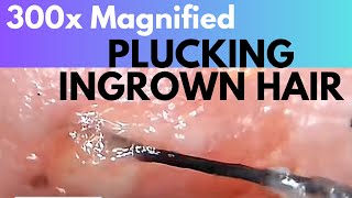 Plucking Ingrown Hair From Underneath Skin at 300x Magnified Black Long Hair With Wet Tip 毛发内生 [upl. by Wehttan]