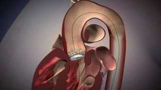 TAVR Edwards Sapien Aortic Valve Deployment [upl. by Cheshire]