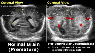 Neonatal Brain Ultrasound Normal Vs Abnormal Images  Full Term Infant amp Premature Newborn Head USG [upl. by Assetniuq]