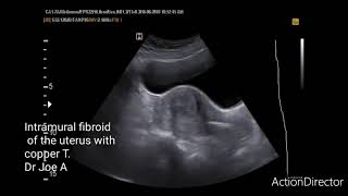 Fibroid vs adenomyosis uterus differences ultrasound scan video [upl. by Lovett]