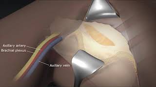 The Axillary Vein 3D Animation of Axillary Lymph Node Dissection Procedure Part  3 [upl. by Ellitnahc286]