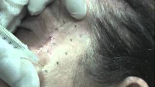 Treatment of goose feet or crow feet with endopeel technic [upl. by Liamsi131]