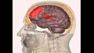 Como Se Lesiona el Cerebro Una Fuerza Positiva Modulo 3 [upl. by Adnalra]