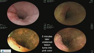 Early Detection of Esophageal Cancer and Barrett’s Esophagus Recent Advances [upl. by Okiram648]