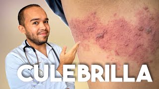 TODO SOBRE LA CULEBRILLA  HERPES ZÓSTER [upl. by Nailil952]