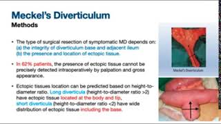 Meckels Diverticulum Wedge Excision vs Segmental Resection Anastomosis [upl. by Urquhart347]