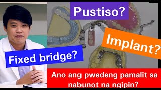 Nabunutan Anu ang Mga Puwedeng Pamalit sa Nabunot ng Ngipin Pustiso Bridge Jacket Implant 19 [upl. by Ykcor]