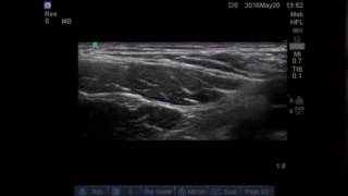 Fascia Iliaca Compartment Block [upl. by Jillian]