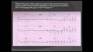 სინუსური ტაქიკარდია არასტაბილური სტენოკარდია მწვავე კორონარული სინდრომი arastabiluri stenokardia [upl. by Benco941]