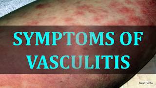 SYMPTOMS OF VASCULITIS [upl. by Ambrosio]