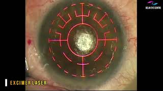 Phototherapeutic Keratectomy or PTK by Dr Ikeda Lal [upl. by Ocirema]