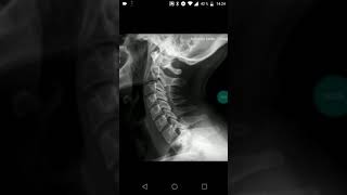 Radiografía de columna cervical Perfil  DESCRIPCIÓN [upl. by Auot23]