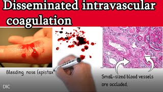 Disseminated intravascular coagulation DIC  Causes Symptoms Treatment and prognosis [upl. by Aura]