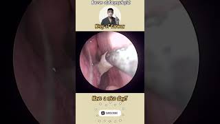 귀지형 콧물 부비동염 축농증 비염 코청소 이비인후과 rhinorrhea rhinitis sinusitis asmr [upl. by Taran]