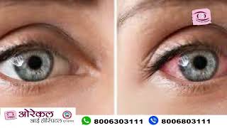 What to do after one eye cataract surgery  Dr Girjesh Kain Eye Specialist youtube trending [upl. by Aihsetal]