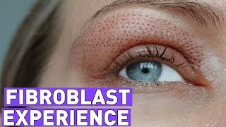 FIBROBLAST treatment experiencebefore and after 7 days [upl. by Victorie]