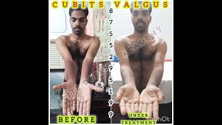 quotSuccessful Cubitus Valgus correction by Dr Manish Bansal at Elite Defence Academy Meerutquot [upl. by Bensen]